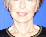 my after picture was taken 1 week after - when I had the stitches removed